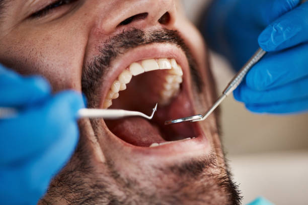 Best Emergency Tooth Extraction in Garrison, TX